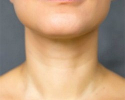 What Botox Can Do for Your Neck