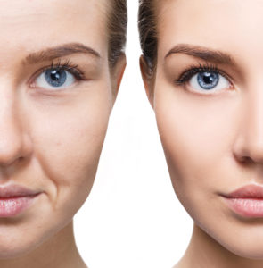 Botox only work on dynamic wrinkles